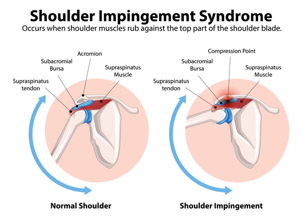 Shoulder Impingement Syndrome