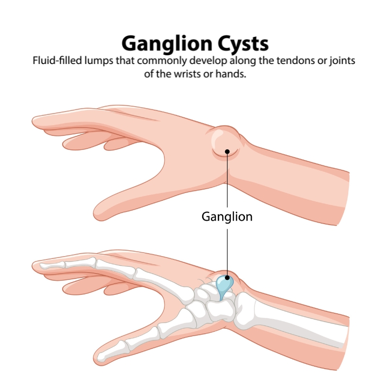 Wrist Ganglion Cyst