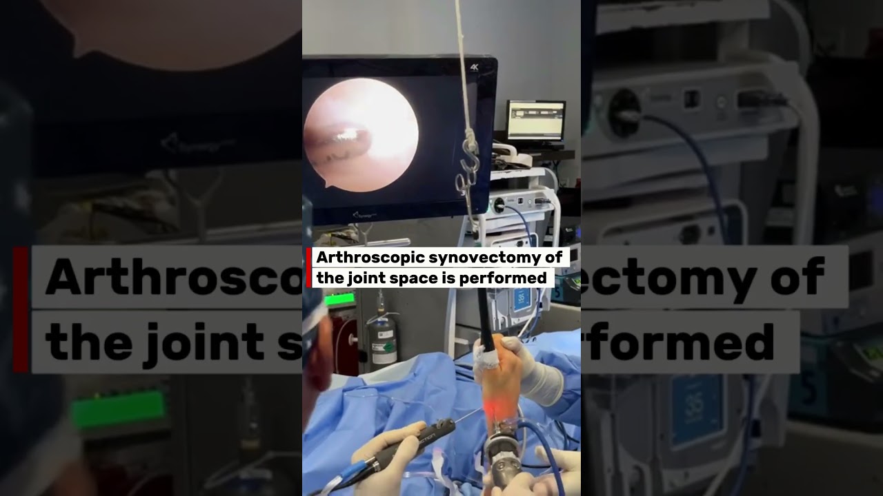 #Livesurgerytuesday Recap: Wrist Arthroscopy For Stt Joint Arthritis