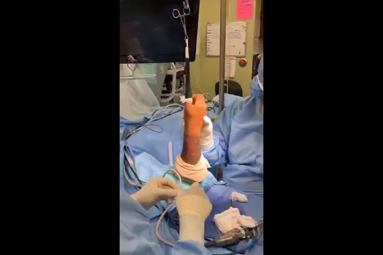 #LivesurgeryTuesday Recap: Thumb MCP Joint Arthroscopy & Thermal Shrinkage